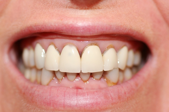 Phục hình răng sứ Veneer