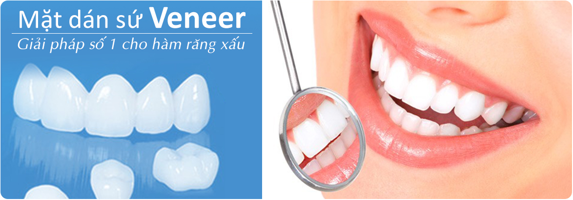 Phục hình răng sứ Veneer