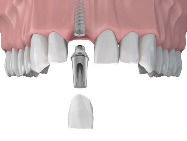 Cấy ghép implant răng cửa